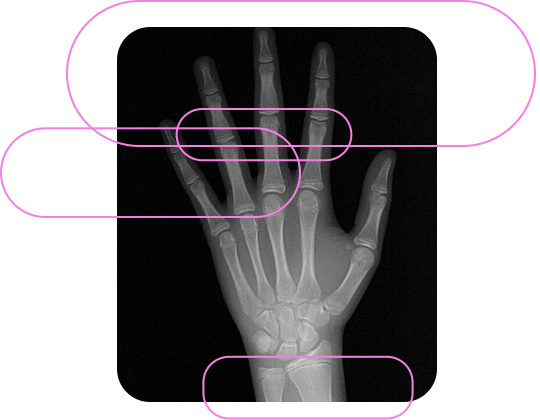 Radiografia de Mão e Punho com Análise Carpal e Idade Óssea